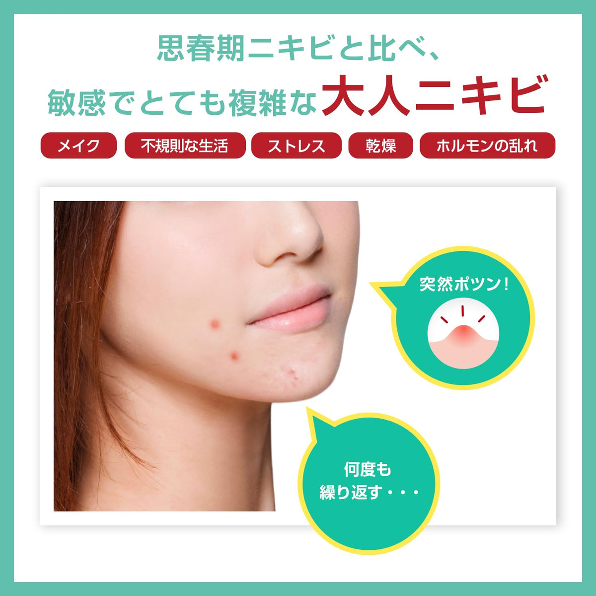 Acne Barrier Medicated Protect Lotion for Adult Acne and Dry Skin, Weakly Acidic Quasi-Drug Herb Lotion, 140 mL